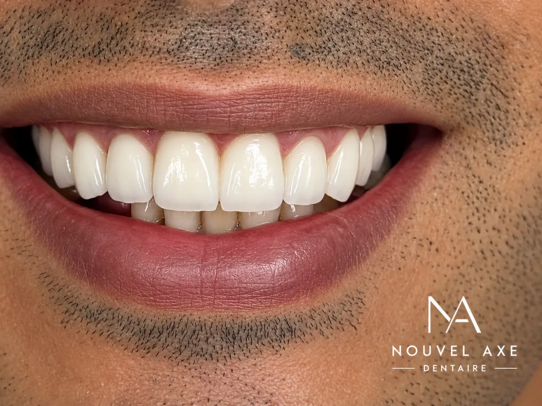 Sourire restauré par des couronnes céramique sur les dents antérieures